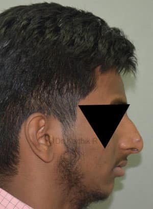 Rhinoplasty (Nose Corrections)
