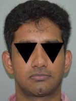 Rhinoplasty (Nose Corrections)