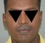 Rhinoplasty (Nose Corrections)