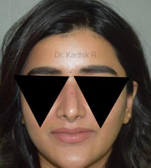 Rhinoplasty (Nose Corrections)