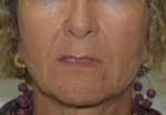 Dermal Fillers