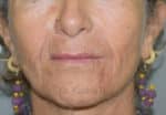 Dermal Fillers