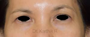 Blepharoplasty