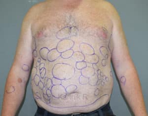 Multiple Lipoma