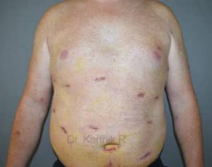 Multiple Lipoma