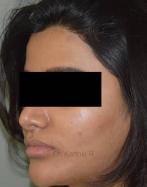 Dermal Fillers