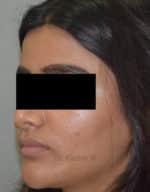 Dermal Fillers