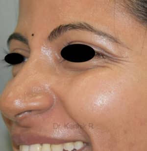 Botox