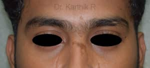 Scar Revision