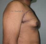 Gynecomastia (Puffy Nipples/ Male Chest Correction)