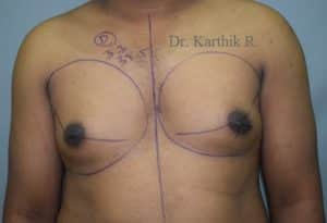 Gynecomastia (Puffy Nipples/ Male Chest Correction)