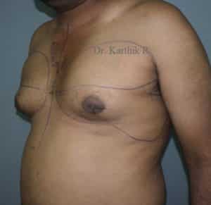 Gynecomastia (Puffy Nipples/ Male Chest Correction)