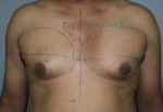 Gynecomastia (Puffy Nipples/ Male Chest Correction)