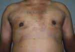 Gynecomastia (Puffy Nipples/ Male Chest Correction)