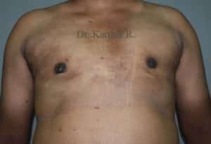 Gynecomastia (Puffy Nipples/ Male Chest Correction)