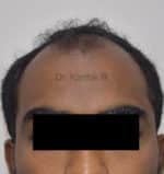 Hair Transplantation