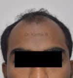 Hair Transplant