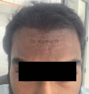 Hair Transplantation