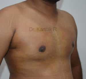 Gynecomastia (Puffy Nipples/ Male Chest Correction)