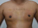 Gynecomastia (Puffy Nipples/ Male Chest Correction)