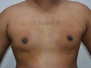 Gynecomastia (Puffy Nipples/ Male Chest Correction)