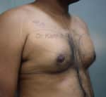 Gynecomastia (Puffy Nipples/ Male Chest Correction)