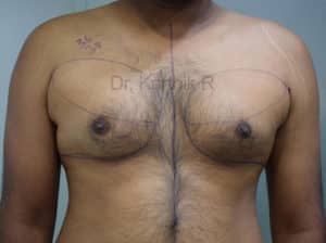 Gynecomastia (Puffy Nipples/ Male Chest Correction)