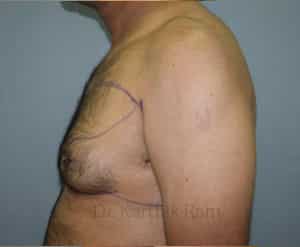 Gynecomastia (Puffy Nipples/ Male Chest Correction)