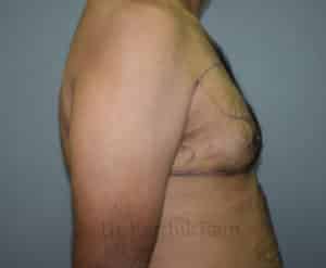 Gynecomastia (Puffy Nipples/ Male Chest Correction)