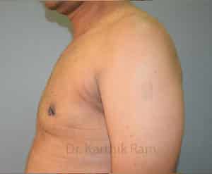 Gynecomastia (Puffy Nipples/ Male Chest Correction)