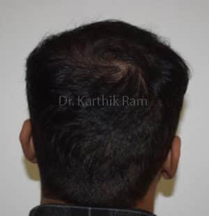 Hair Transplantation