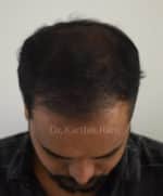 Hair Transplantation