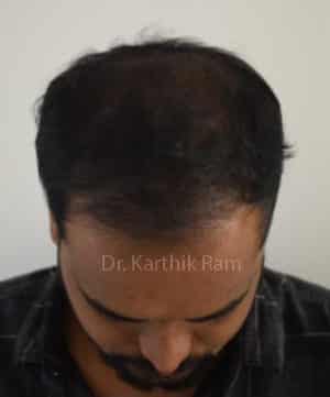 Hair Transplantation