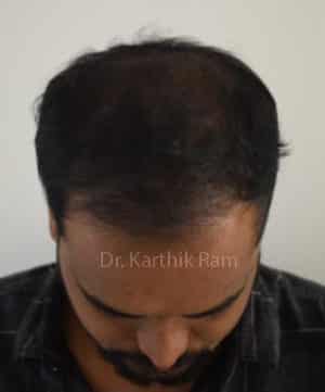 Hair Transplant