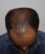 Hair Transplantation