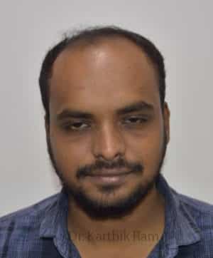 Hair Transplantation