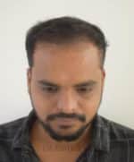 Hair Transplantation