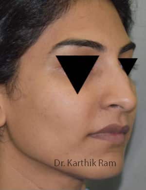 Rhinoplasty (Nose Corrections)