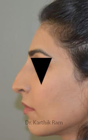 Rhinoplasty (Nose Corrections)