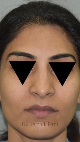 Rhinoplasty (Nose Corrections)