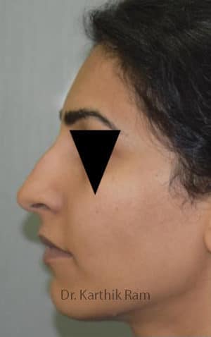 Rhinoplasty (Nose Corrections)