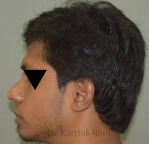 Rhinoplasty (Nose Corrections)