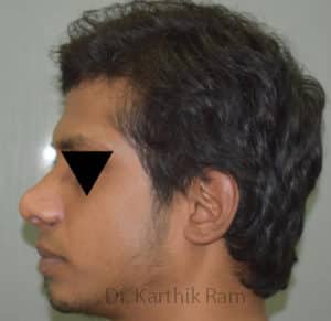 Rhinoplasty (Nose Corrections)