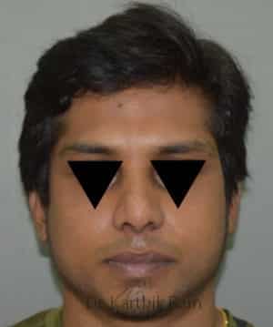 Rhinoplasty (Nose Corrections)