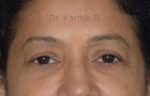 Blepharoplasty