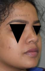 Rhinoplasty (Nose Corrections)