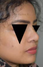 Rhinoplasty (Nose Corrections)