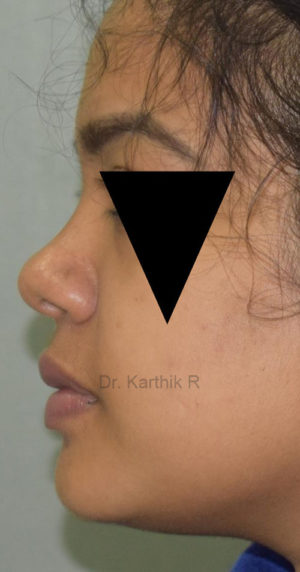 Rhinoplasty (Nose Corrections)