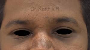 Under Eye Fat Fill
