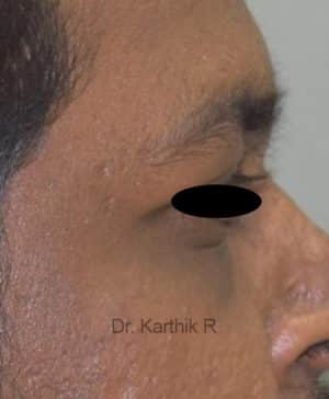 Under Eye Fat Fill
